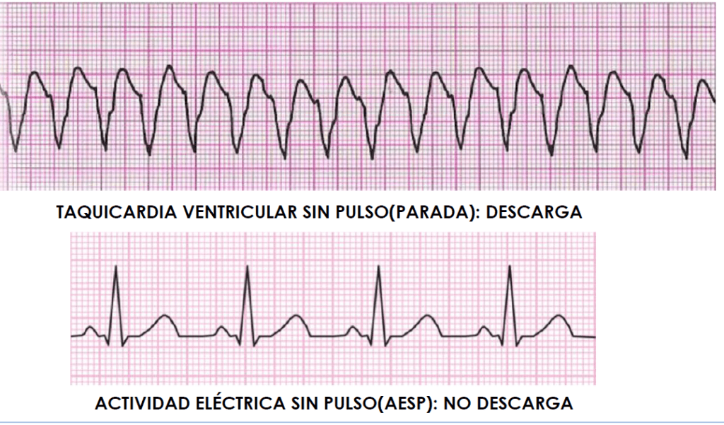 taquicardia ventricular sin pulso y actividad eléctrica sin pulso